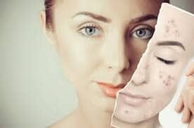 Αντικατάσταση του Botox