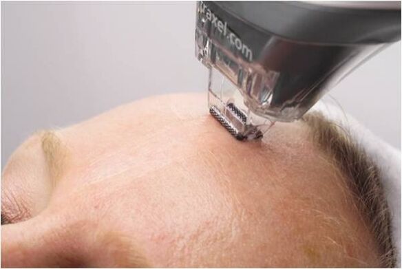 διαδικασία peeling για την αναζωογόνηση του δέρματος του προσώπου